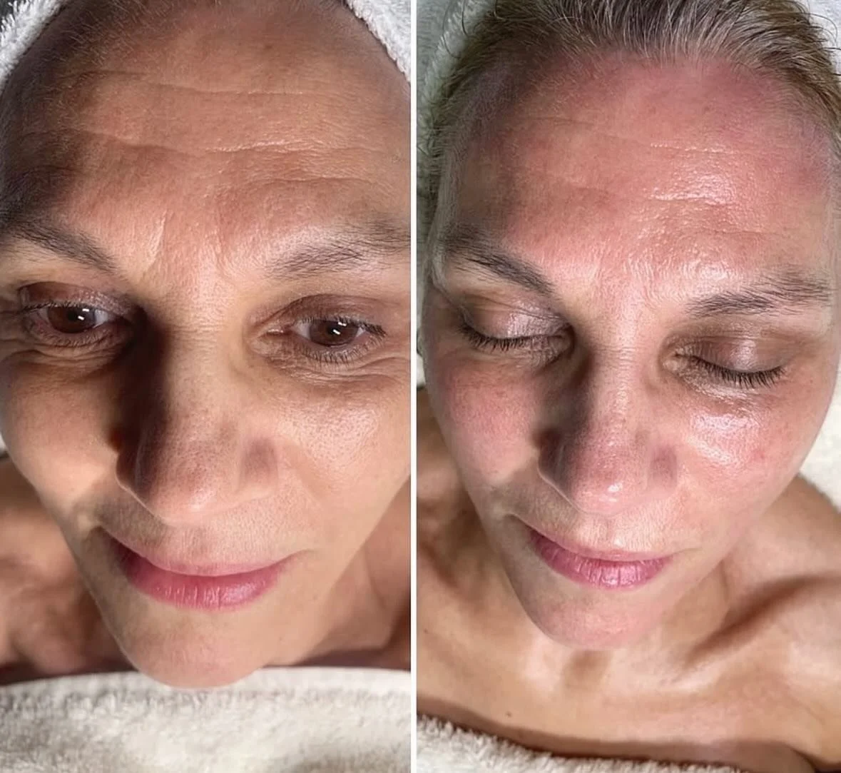✨ Next-level skin transformation! ✨

This incredible before-and-after by @facialessences shows the power of PRX Treatment + Hydra-Facial at Facial Essences! 💦🔬 A deep hydration boost combined with skin regeneration for firmer, brighter, and healthi