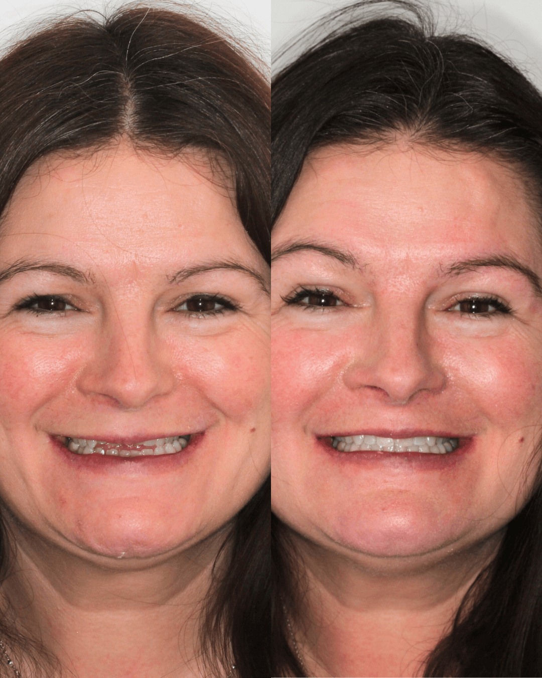 Orthodontic-Open Day-chiswell-green-st-albans-before-after.png