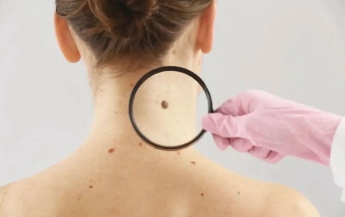 Check your moles!
🚨
Here are some easy top tips by our member @skinspire.medical to help you know when to see your doctor and check out any worrying moles that could be a sign of skin cancer.⠀
⠀
🔺Regularly check your moles - If they are in areas yo