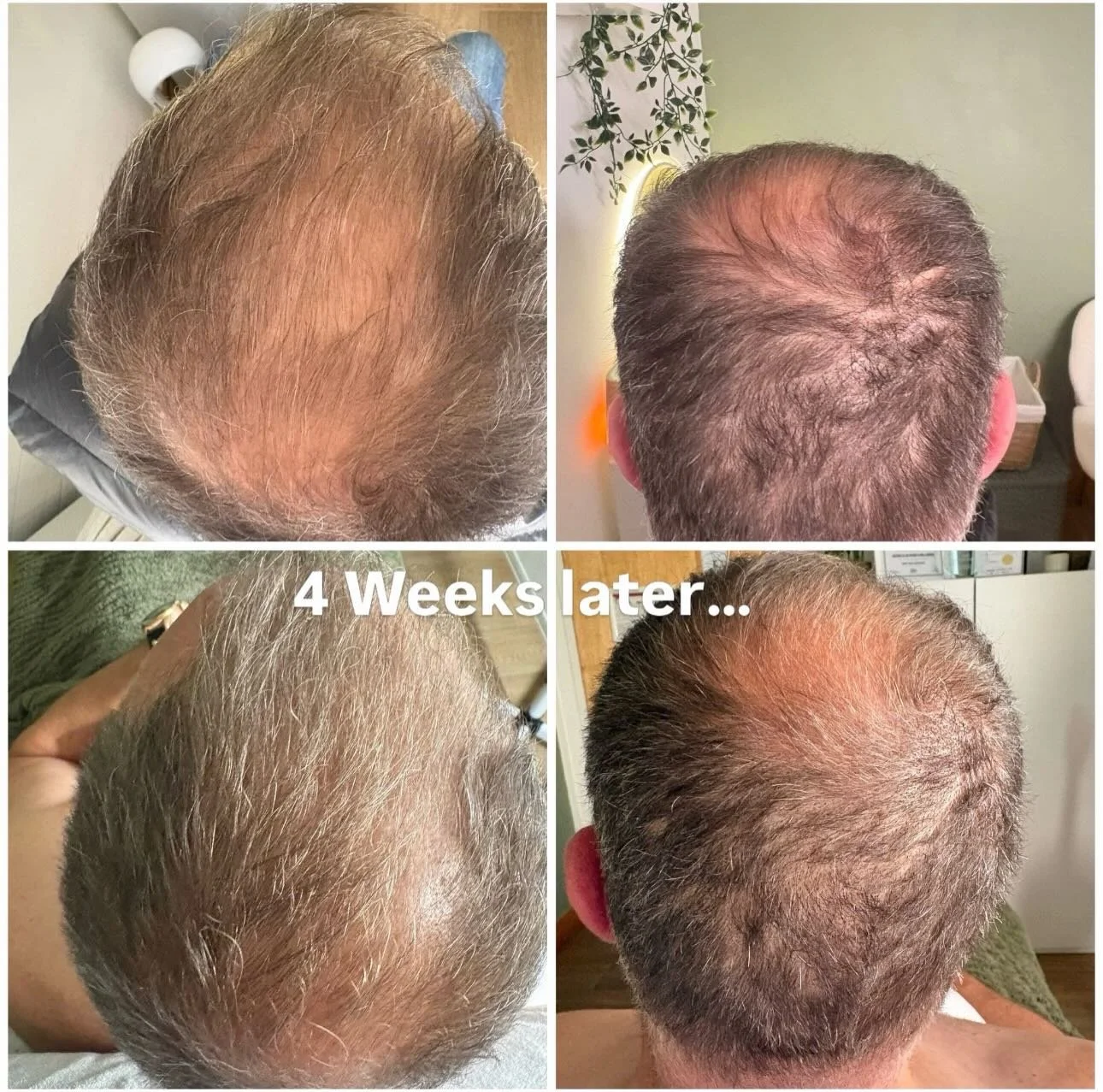 Hair Loss Transformation by our member @jessicabower_wellness , in just 4 Weeks! 
✨ Dealing with hair loss can feel frustrating,  but early intervention and consistent scalp care can make a real difference  💆&zwj;♂️
These before &amp; after results 