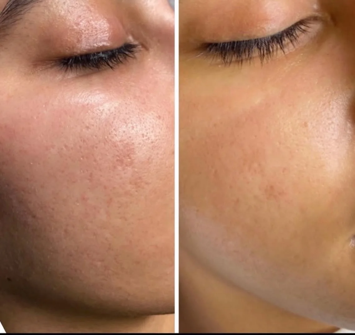 💫 Skin Texture Transformation 💫
 Look at these amazing results from our member @facialessences 
🔍
After just one SkinPen Precision treatment, notice smoother, healthier-looking skin.
🧖&zwj;♀️
Why choose SkinPen over standard microneedling devices