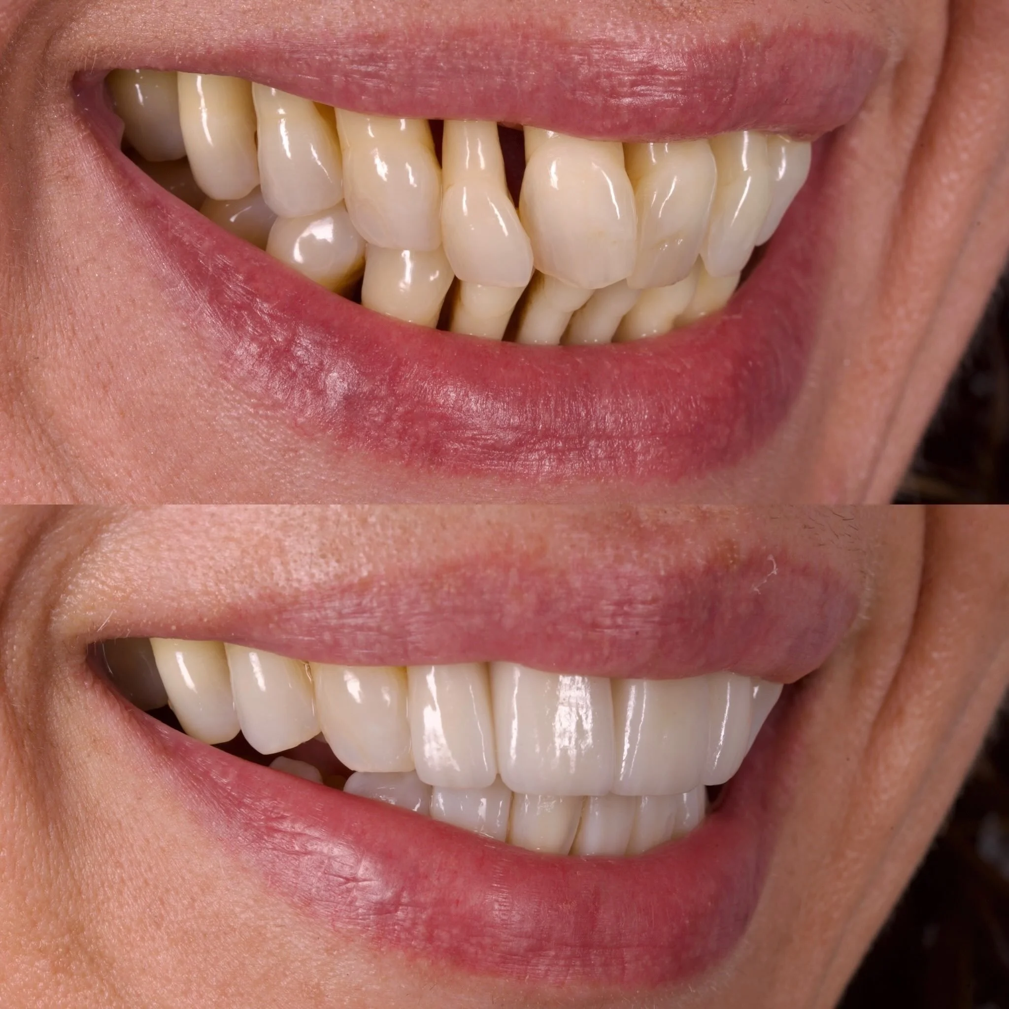 Another amazing result by our member @ukdentalspecialists 
🦷 
In this case, the aesthetic aspect of treatment was carried out by the incredible specialist prosthodontist Dr @kostas_karagiannopoulos helping to restore both function and confidence in 