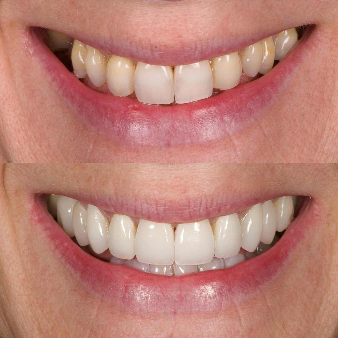Patient results by our member @ukdentalspecialists 
💫
Improving a smile isn&rsquo;t always about making teeth bigger or brighter. In this case, nine ceramics were used to refine proportions, form and colour, creating a more harmonious and balanced r