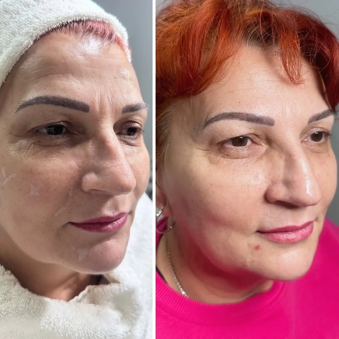 🧖 Tailored Skin Booster, in action. 🧖

For this transformation our member @facialessences used a skin revitalisation treatment designed to improve the quality, hydration and overall appearance of the skin.
💫
Combining hyaluronic acid with a carefu
