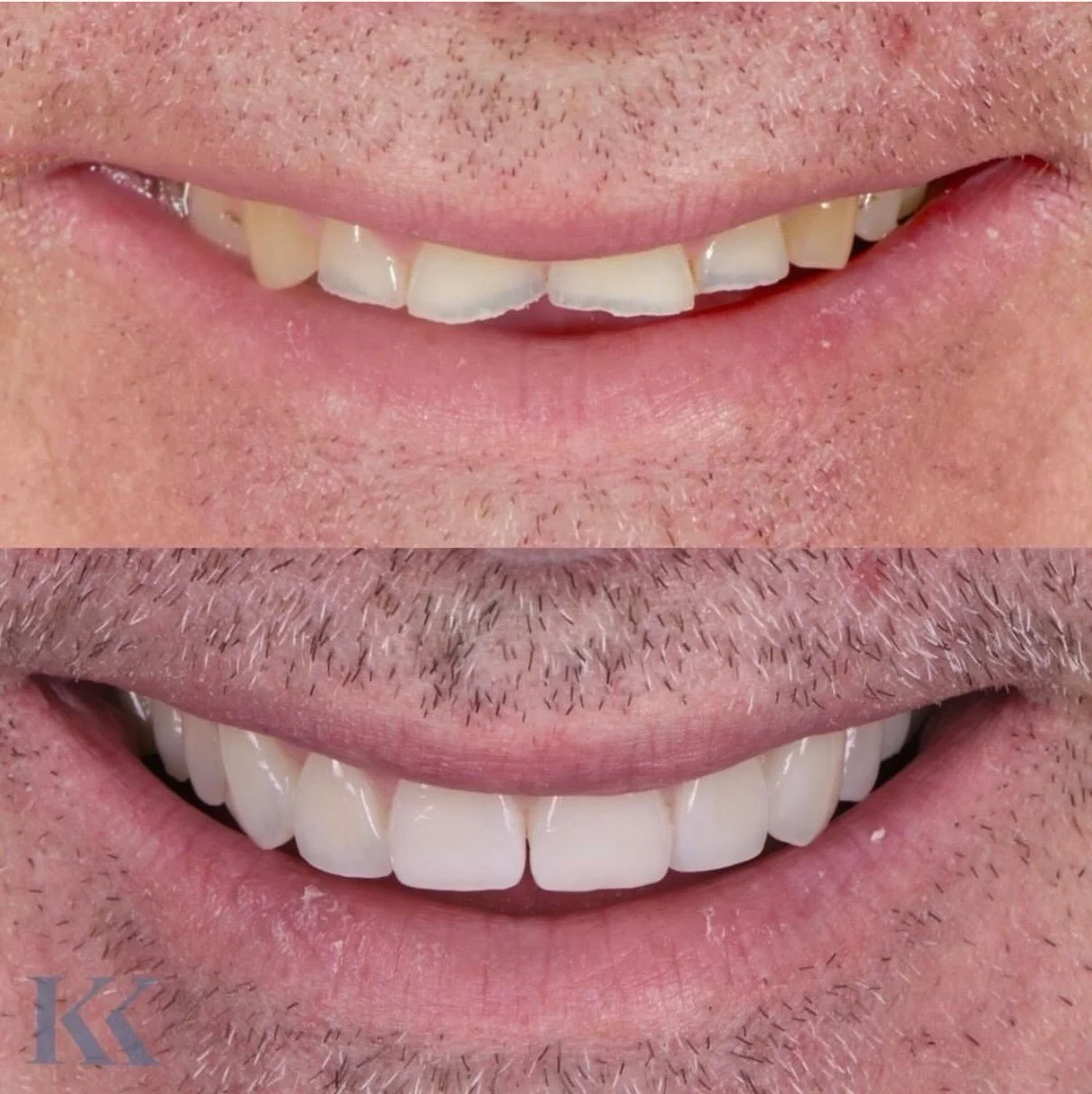 🦷 Smile Transformation Alert! 🦷

Our member @ukdentalspecialists has worked magic on this stunning smile! 
💫
Featuring the incredible skills of Specialist Prosthodontist @kostas_karagiannopoulos on the restoration, and Specialist Periodontist &amp