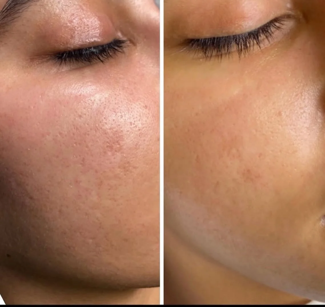 ✨ How ONE treatment can transform your skin! ✨

These are the real results after just one SkinPen Precision treatment at @facialessences 

Smoother, rejuvenated, and glowing skin in just one session!

Thinking of trying it out? Speak with the team to