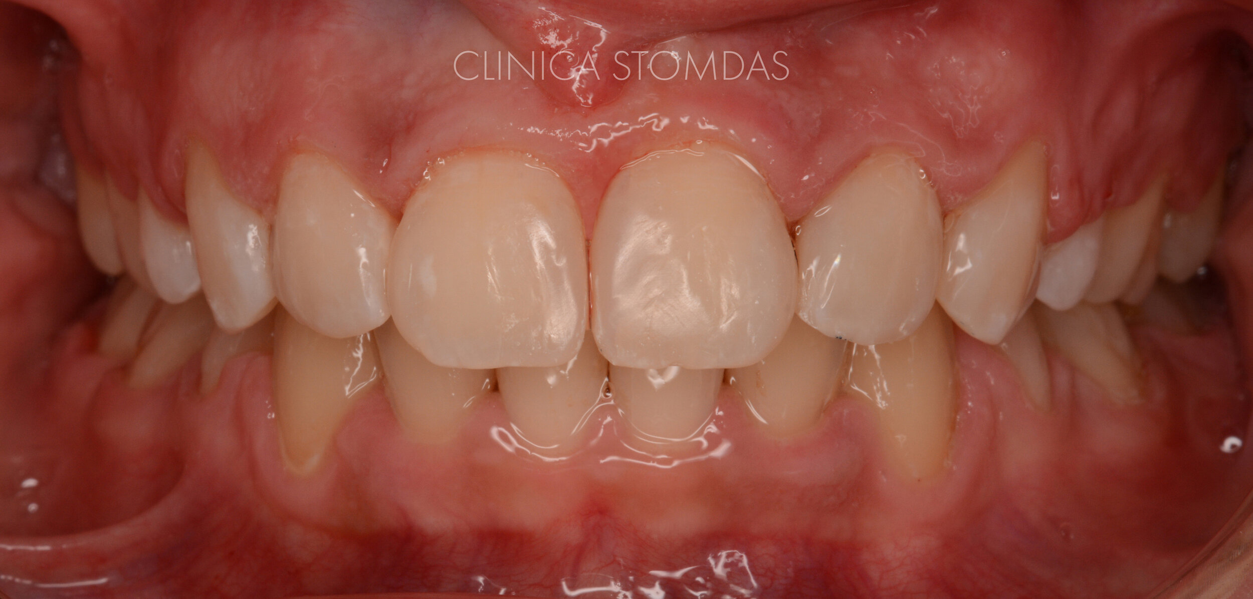 After tratament ortodontic + fatetare directa cu rasini compozite 1.jpg