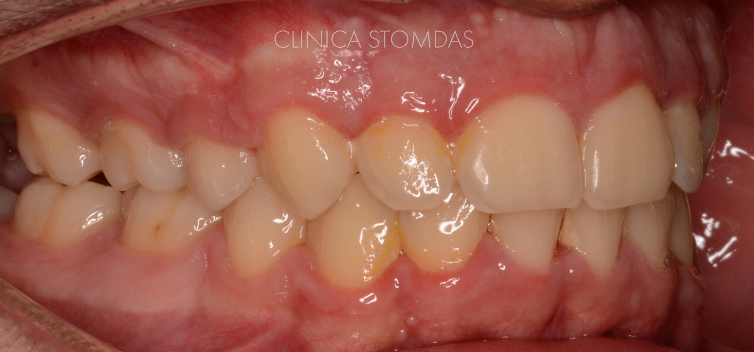 After tratament ortodontic 2.jpg