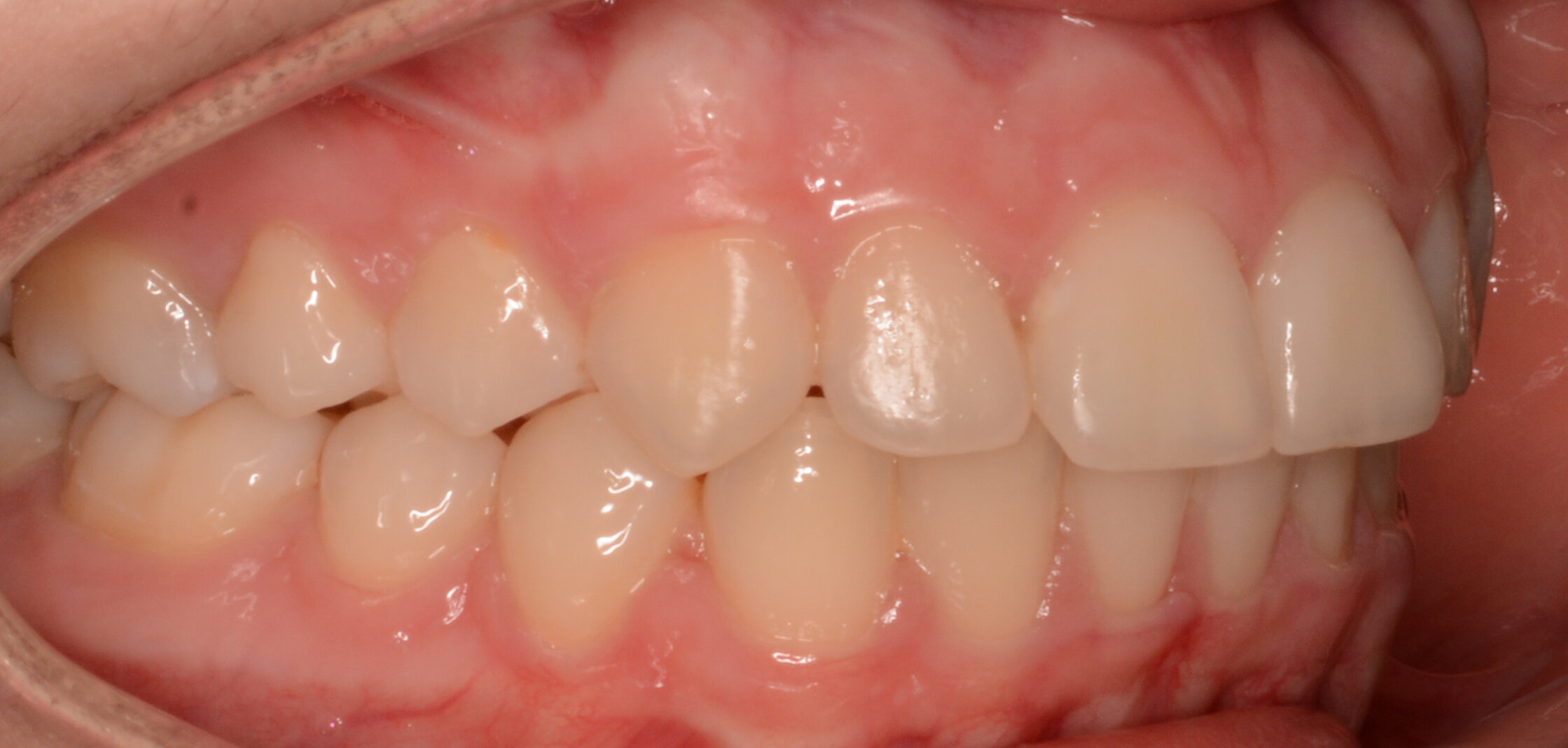 After tratament ortodontic 2.jpg