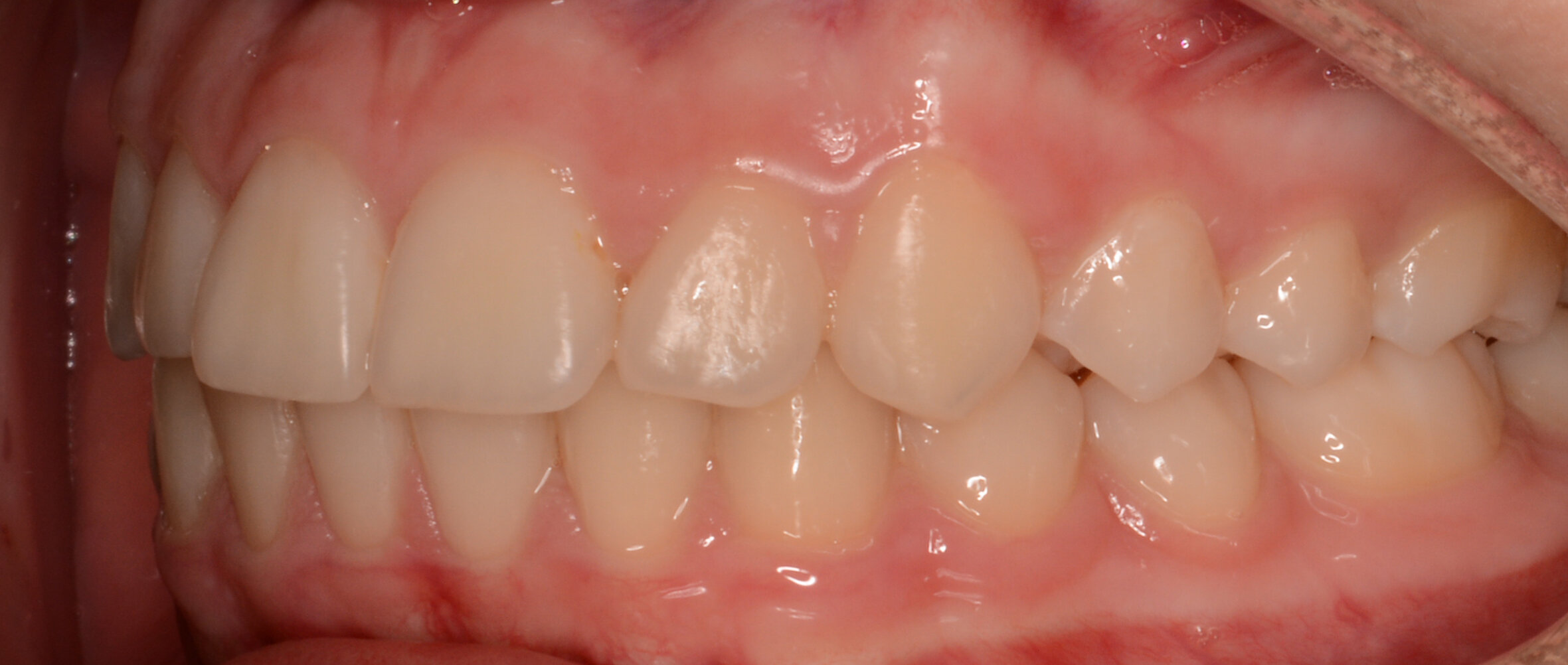 After tratament ortodontic 3.jpg