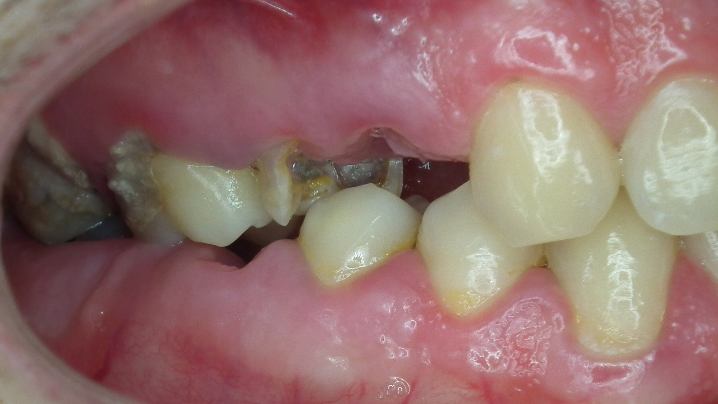 tide Coping then 4 motive pentru care sa porti aparat dentar inainte de inserarea  implanturilor — STOMDAS
