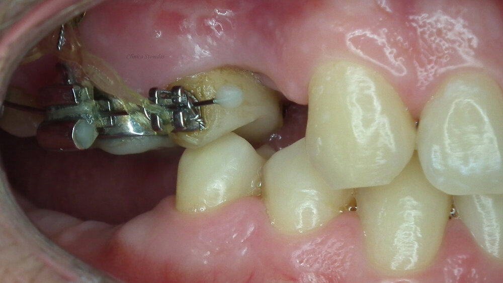 tide Coping then 4 motive pentru care sa porti aparat dentar inainte de inserarea  implanturilor — STOMDAS