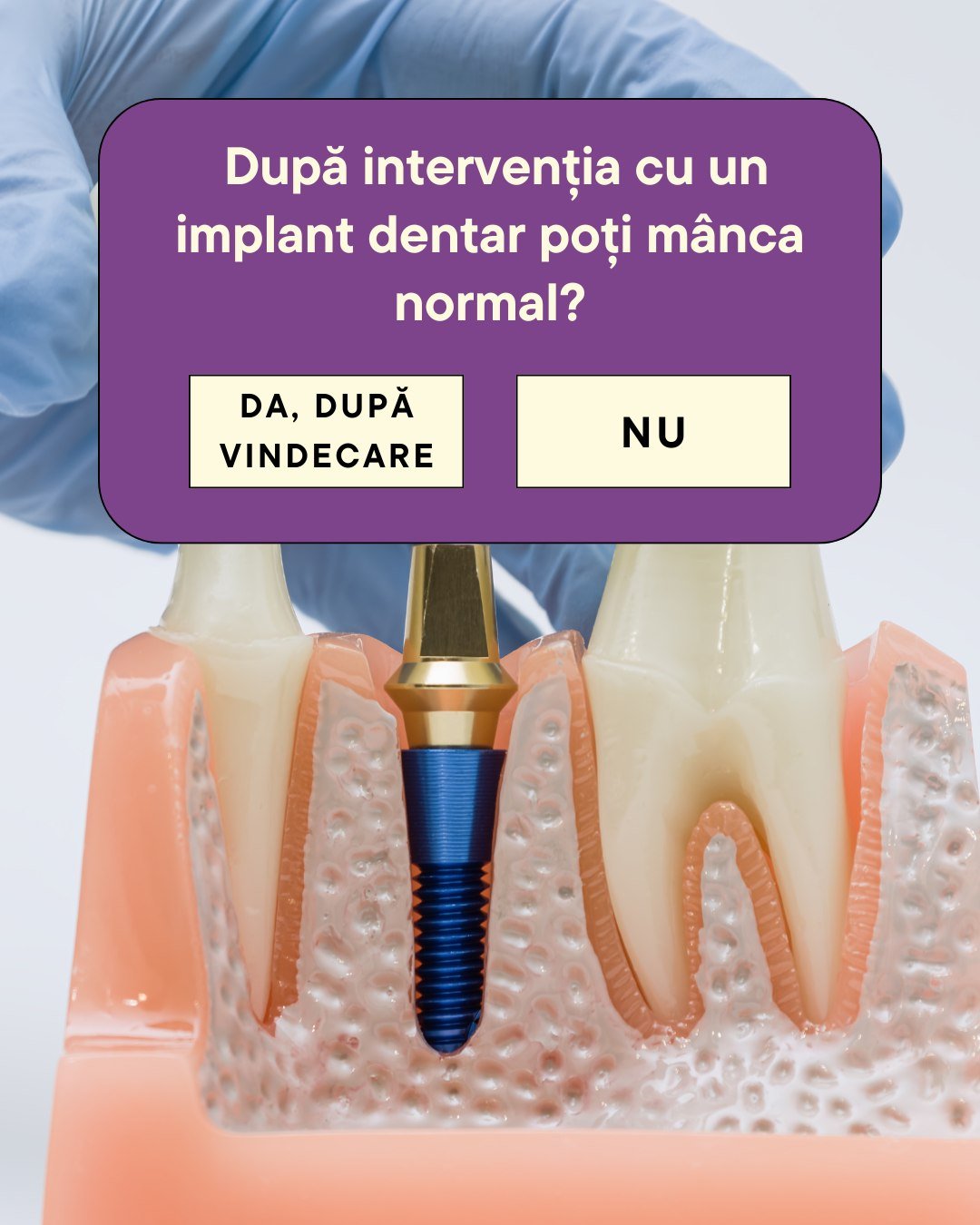 Dacă ai ales A. Da, după vindecare, ai perfectă dreptate! 🎉

Implantul dentar este conceput special pentru a-ți reda 100% din forța masticatorie și libertatea de a savura preparatele preferate. Totuși, trecerea de la operație la &bdquo;m&acirc;ncatu