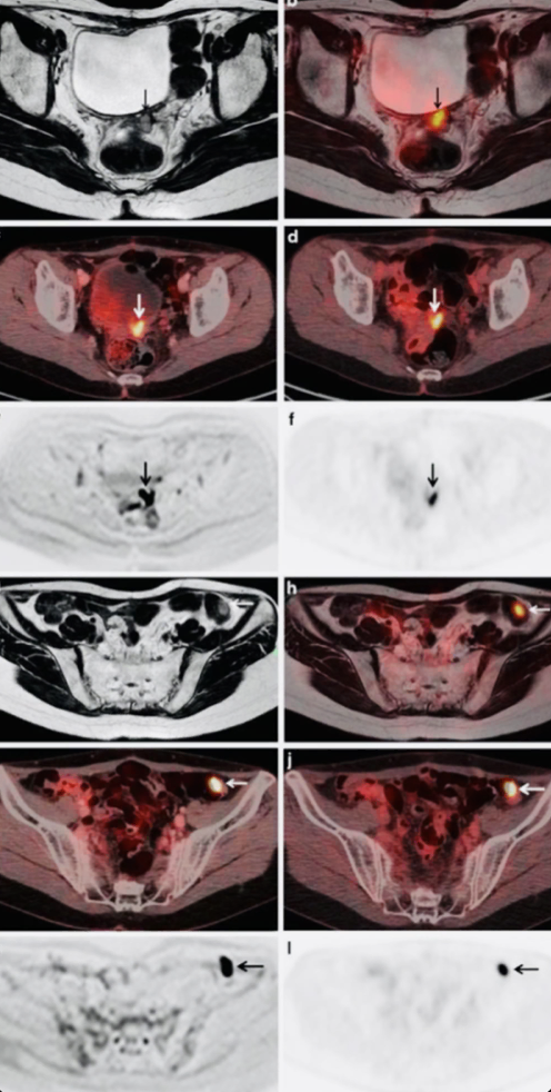 Persistent Pelvic Pain