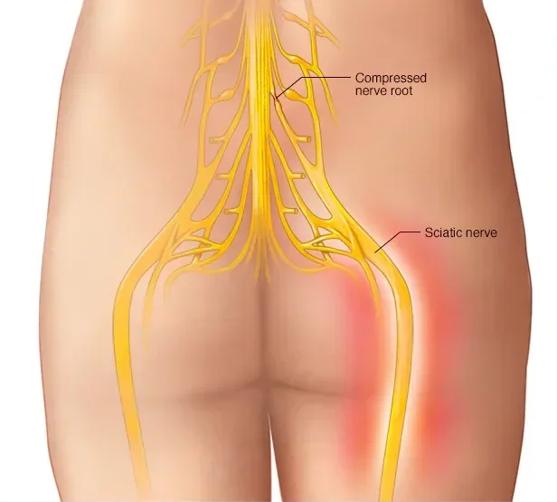 Sciatica: What It Is, Why It Happens and How Physio Gets You Out of Pain