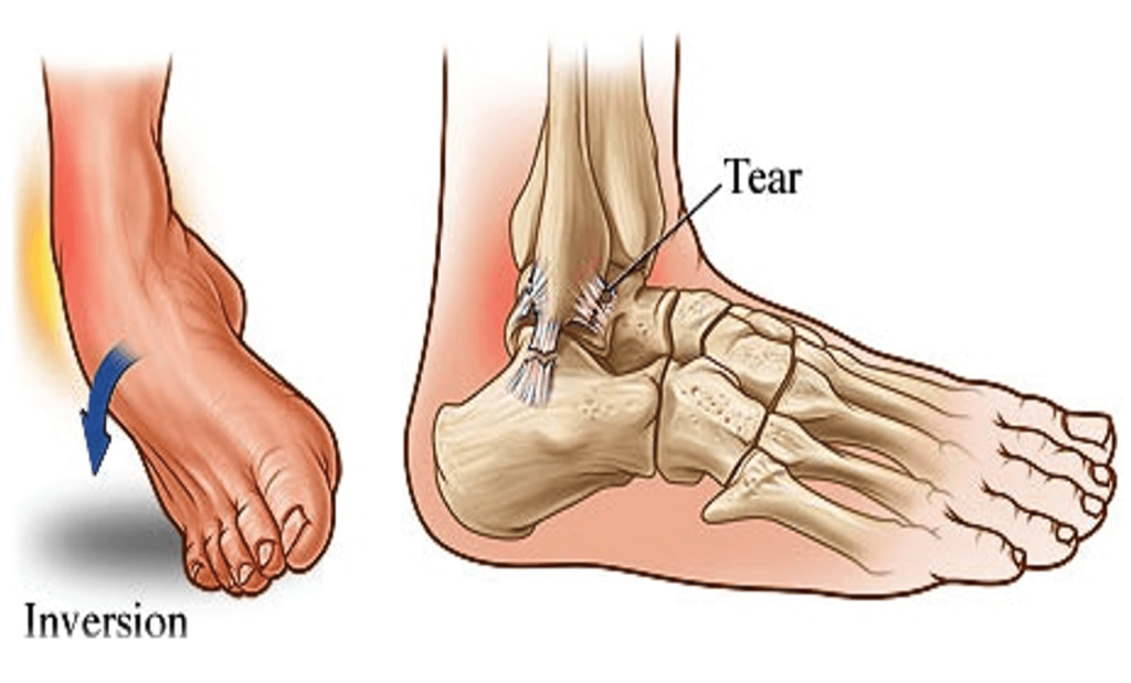 Rolled Your Ankle and Hoping It Will Just Heal? Here Is Why It Often Does Not