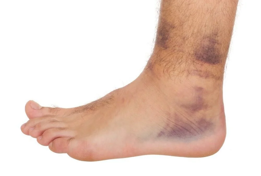 Sprained Ankle Not Getting Better? Here Is What Works.