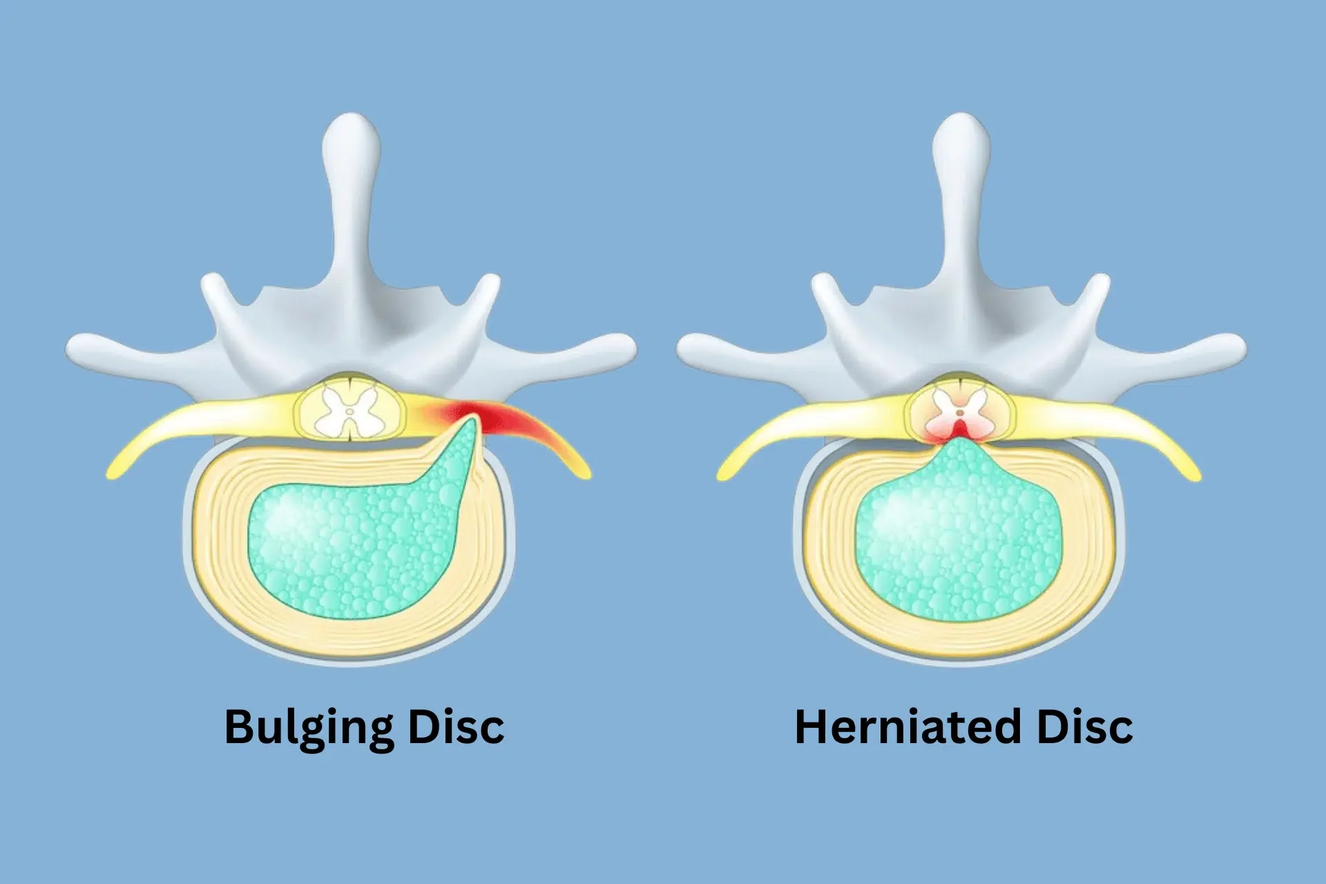 Disc Bulge vs Disc Herniation: What Is the Actual Difference?