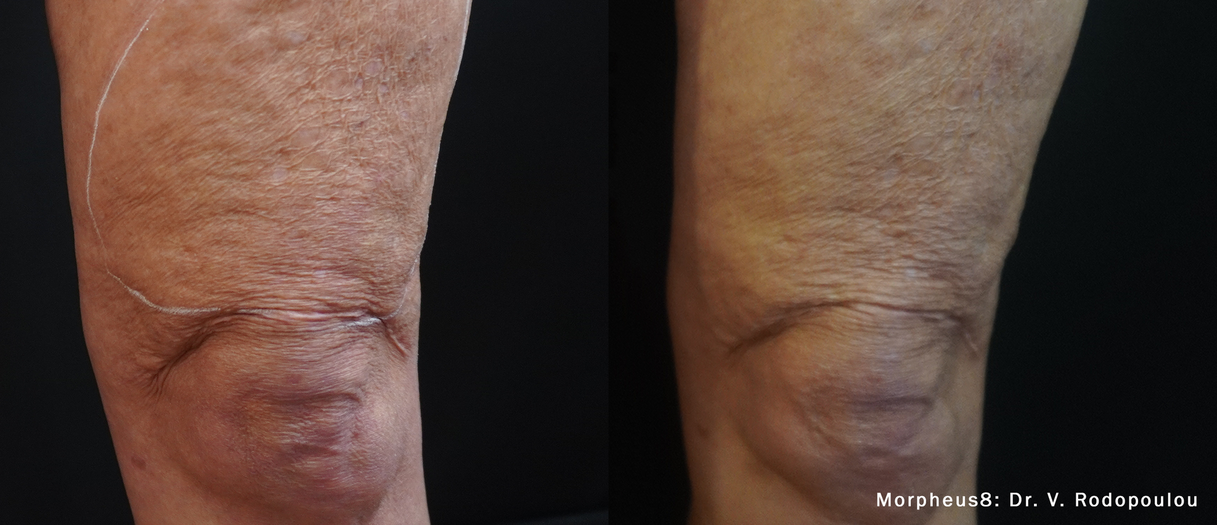 VR_Morpheus8_1dZoom_1txThighs63yrs.png