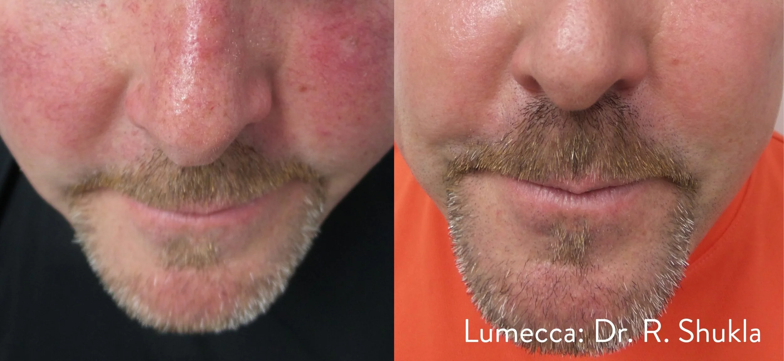 RS_1c_Lumecca_Frontal-scaled.jpg