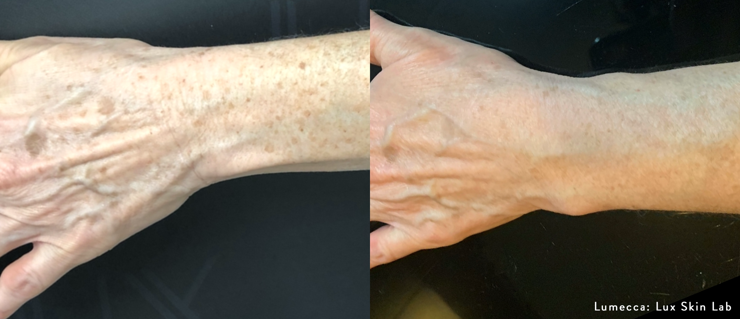 LuxSkinLab_Lumecca_2_1txHand.png