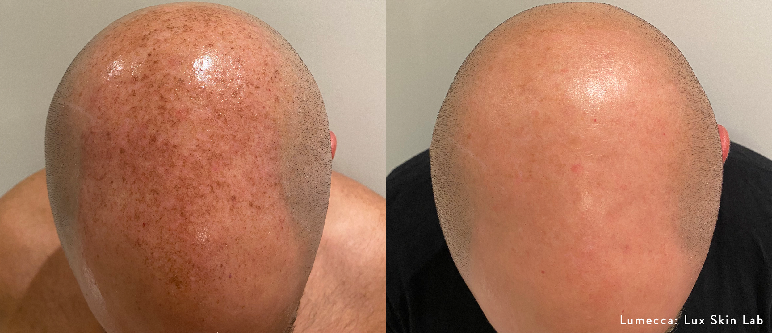 LuxSkinLab_Lumecca_1_1txScalp.png