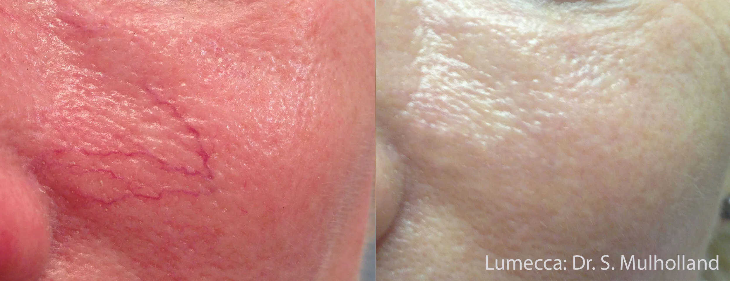 SM_Lumecca_1a_Cheek.jpg