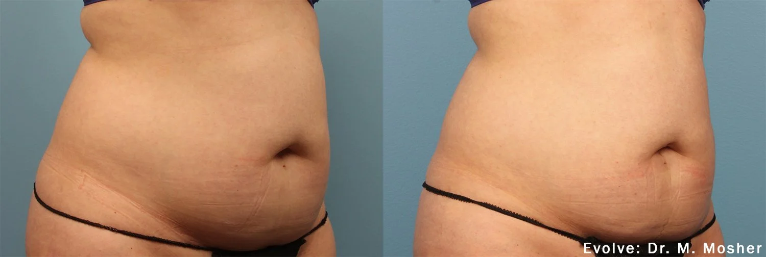 MM_Evolve_1a_Abdomen.jpg