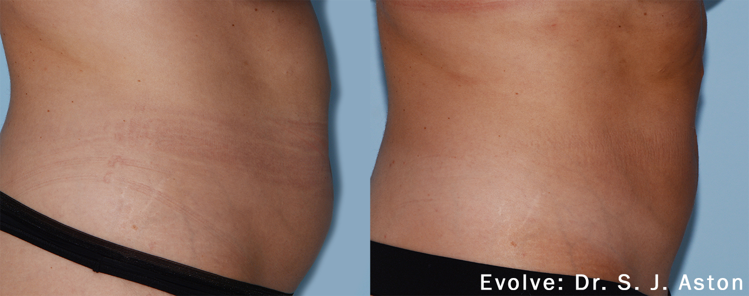 SJA_Evolve_1a_abdomen.png