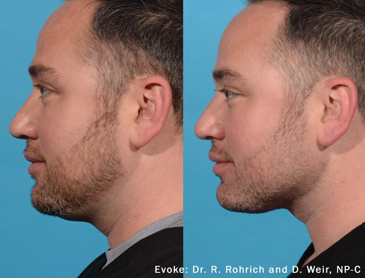 RRDW_Evoke_1a_NeckLeft.jpg
