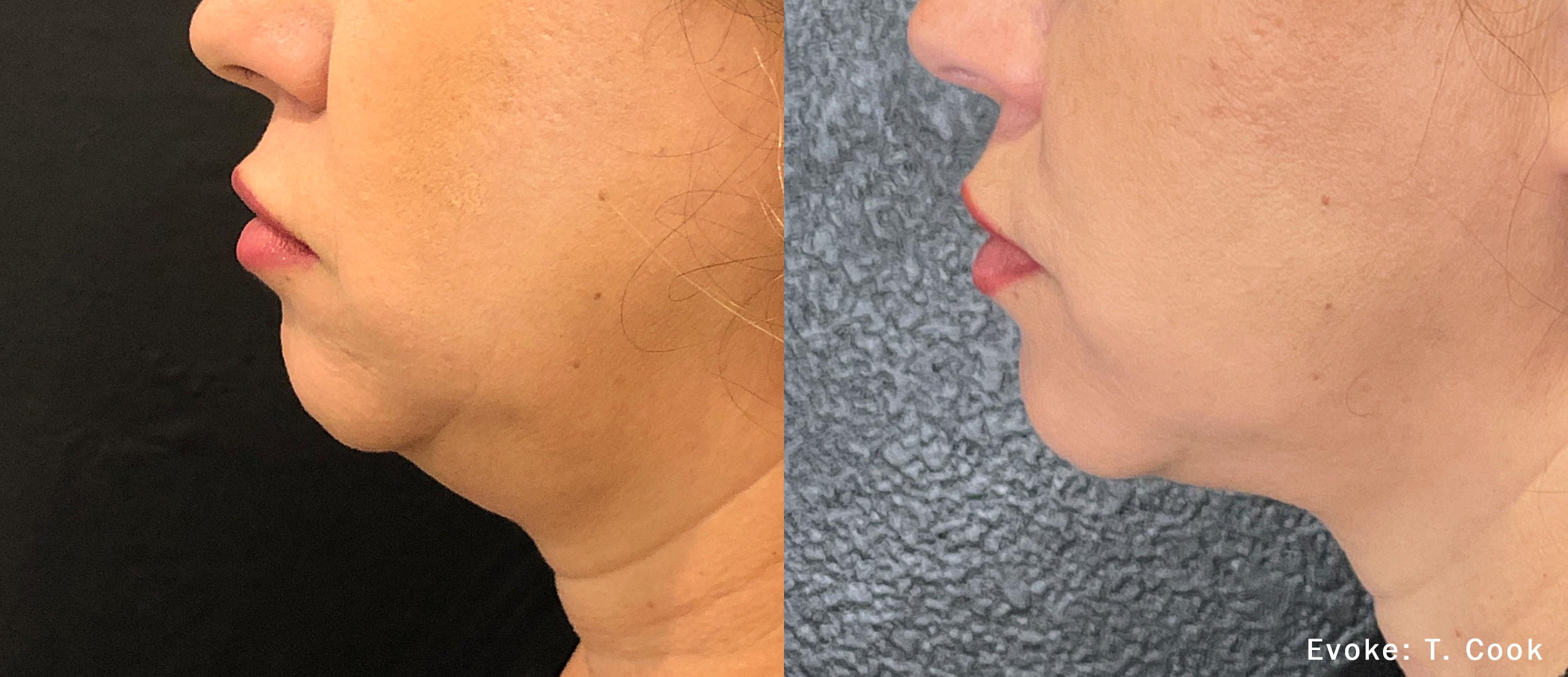 TC_Evoke_1a7weeks_Chin.png