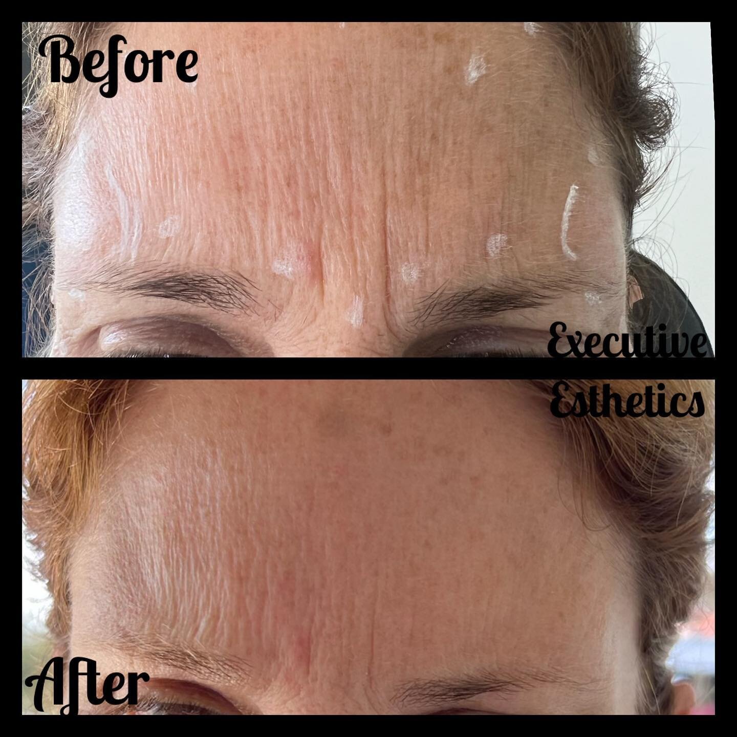 Swipe for Forehead

Neurotoxins 

What are neurotoxins? Neurotoxins, also known as Botox, Dysport, and Xeomin are injectable solutions that temporarily block nerve receptors in the muscle, preventing lines and wrinkles from forming. They can be used 