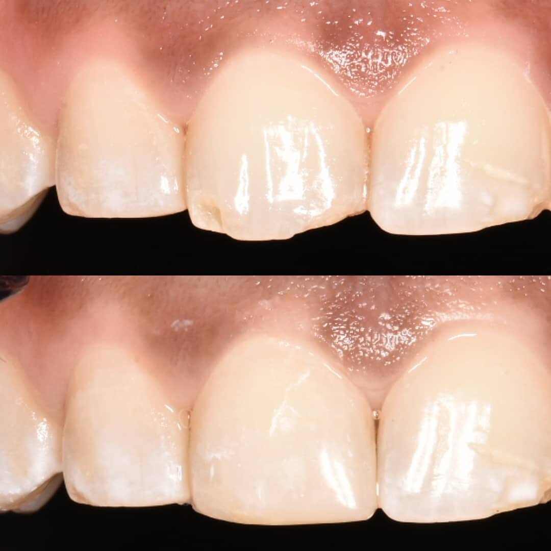 Simple and conservative fix for this chipped tooth using composite filling materials!  These chompers are now ready for the holidays! ❄️☃️🌲🎄🎅🦃
.
.
.
.
.
.
.
.
.
.
#chistmasmiracle #readyforchristmas #dentistry #dentist #cosmeticdentistry #aesthet