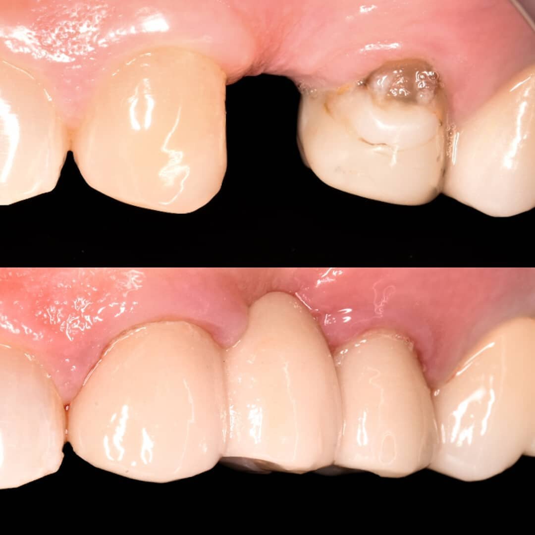 Missing a tooth? As good as implants are, sometimes a good old-fashioned porcelain bridge is a better choice! 🌁This patient has structurally compromised teeth infront and behind the space due to large fillings and would have benefitted from having c