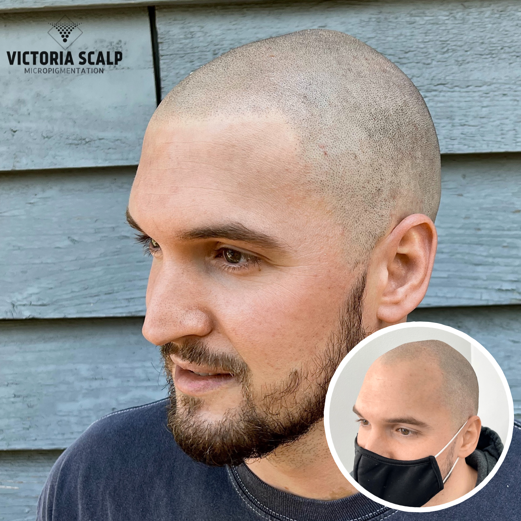 VICTORIA SCALP MICROPIGMENTATION