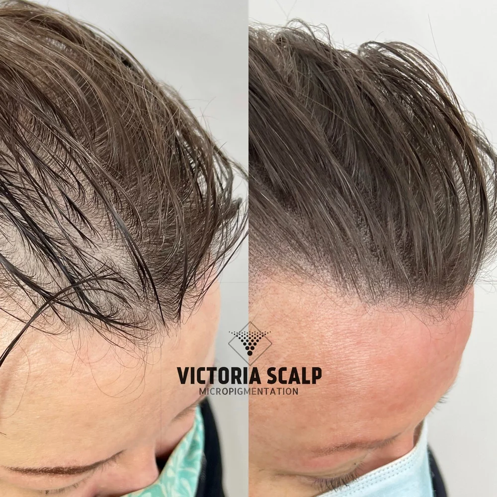 VICTORIA SCALP MICROPIGMENTATION