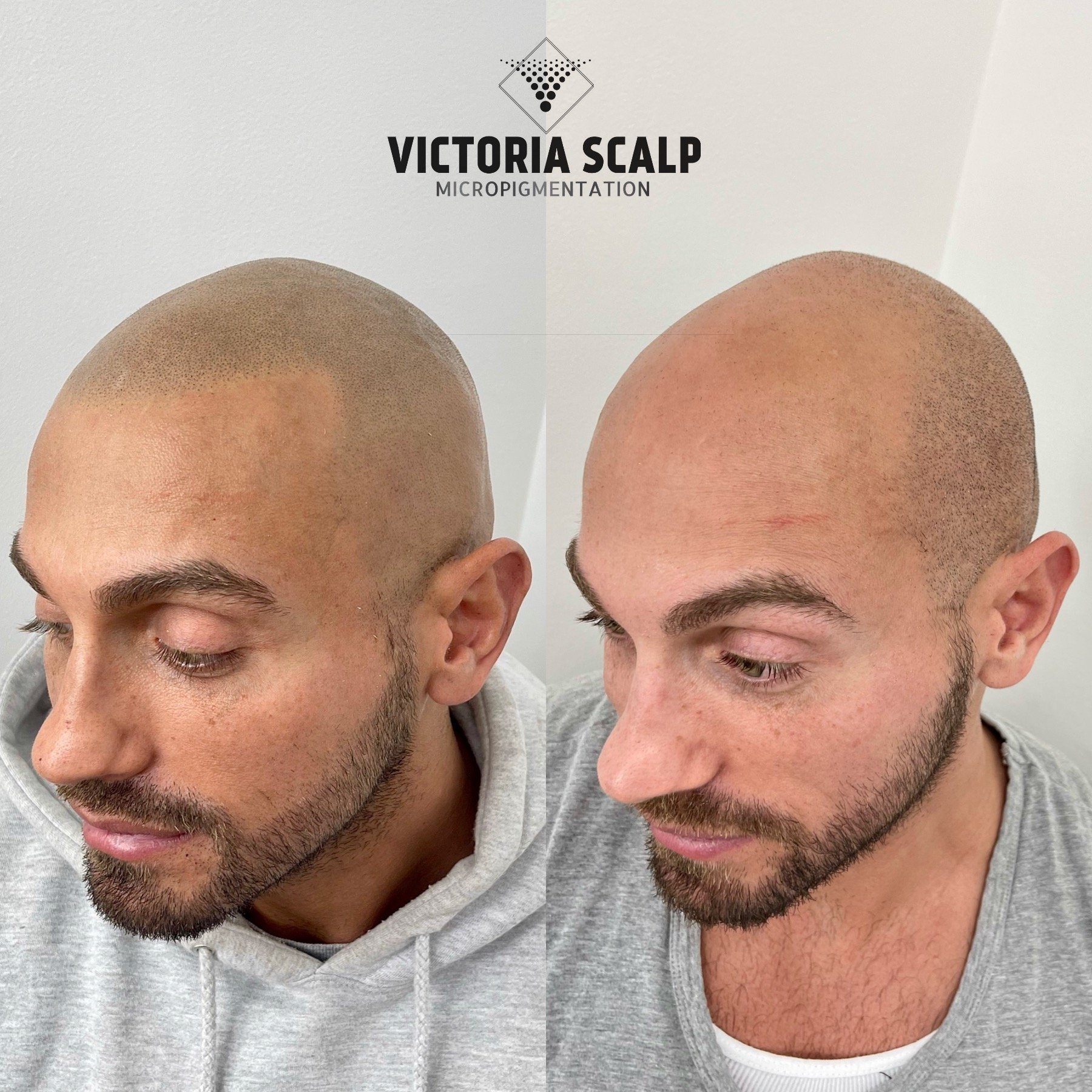 Scalp Micropigmentation for Hair Loss