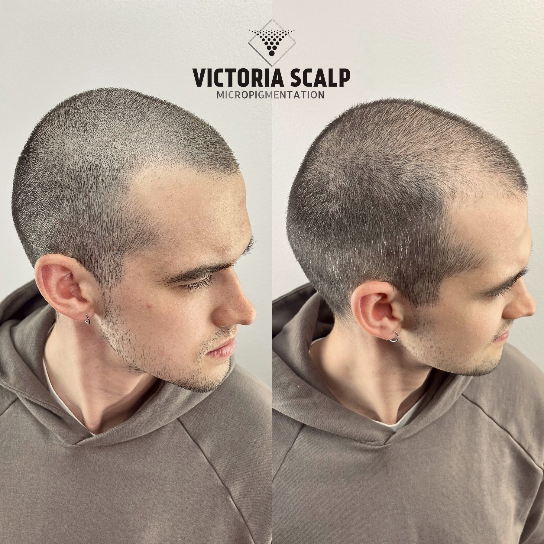 Hair tattoos, might be the best choice for those dealing with uncomfortable  hair loss. — Got Scalp