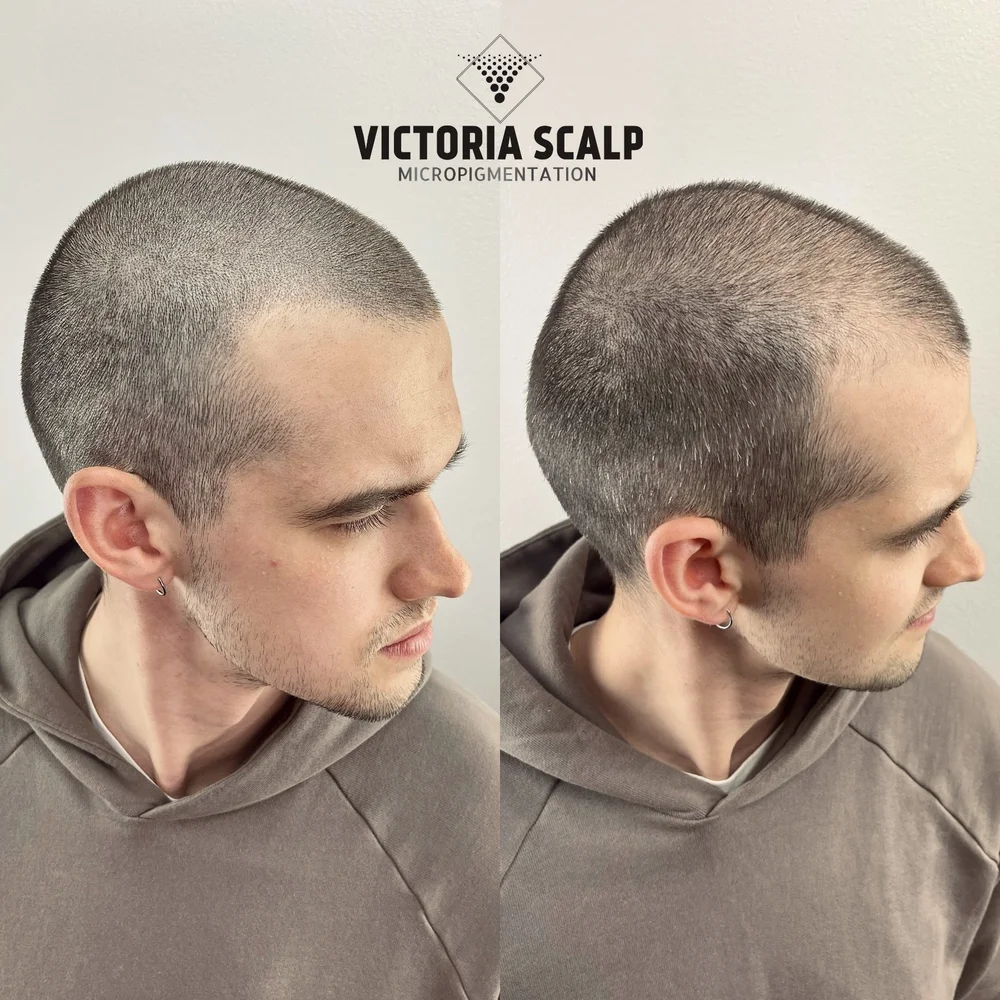 VICTORIA SCALP MICROPIGMENTATION