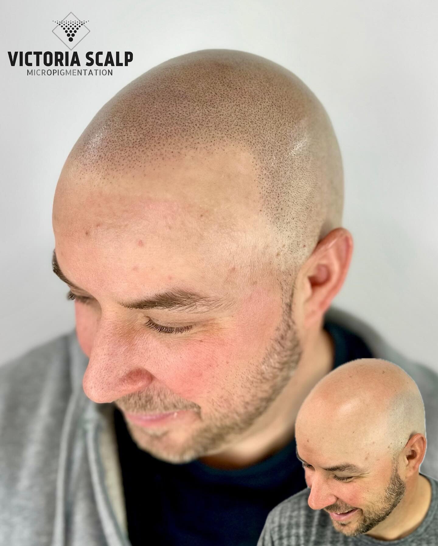 💥FINAL RESULTS 💥
&bull;crown to hairline SMP&bull;
&gt;&gt;&gt;SWIPE for ZOOMables

Norwood 7 transformation. Natural, soft hairline for this client! Even with the rotary shave&hellip;this was a big job. That was a HARD 7 🤣 * fresh impressions wil