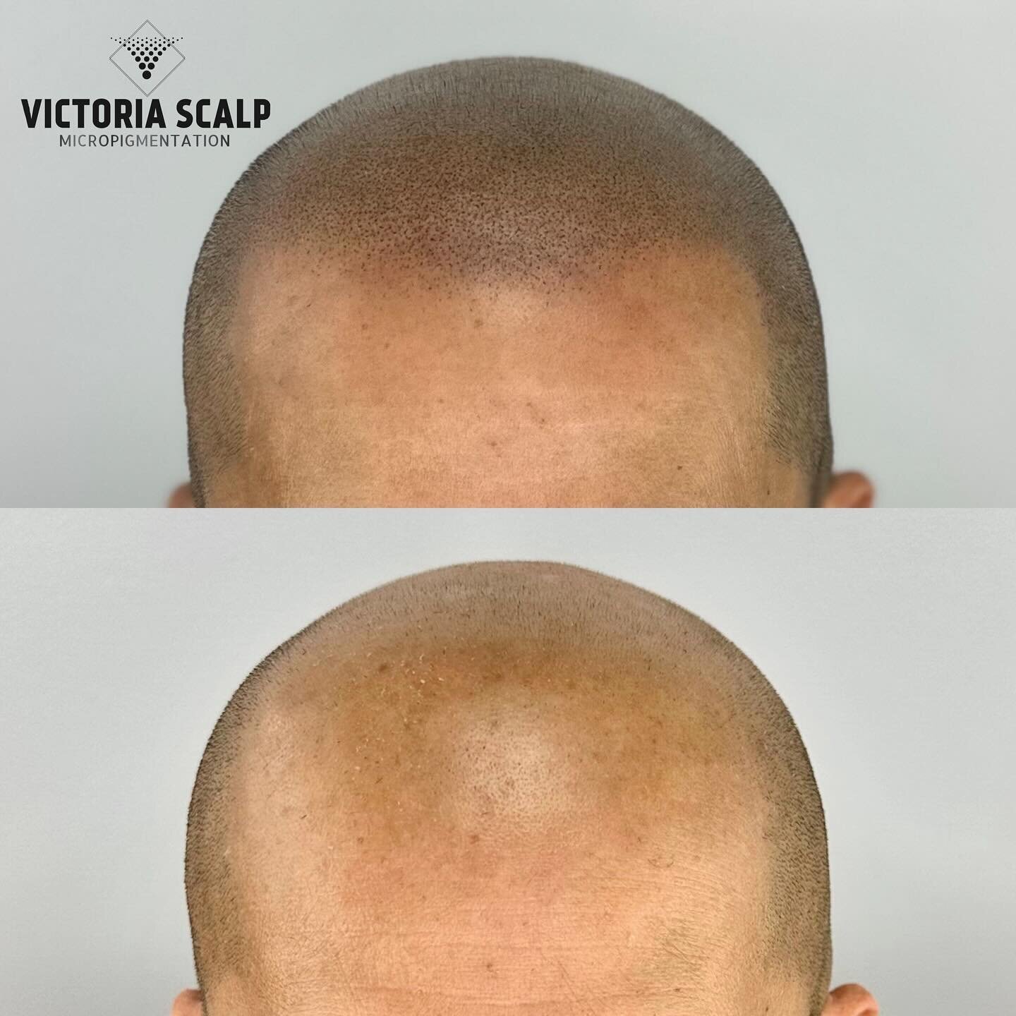 &bull;CROWN TO HAIRLINE SMP&bull; 🔥🔥🔥
Before &amp; After 3 Sessions
&bull;training model final result&bull; 
&gt;&gt;&gt;SWIPE for full zoomable images 

A big thank you to Danny for being part of our training as a model. Students completed first 
