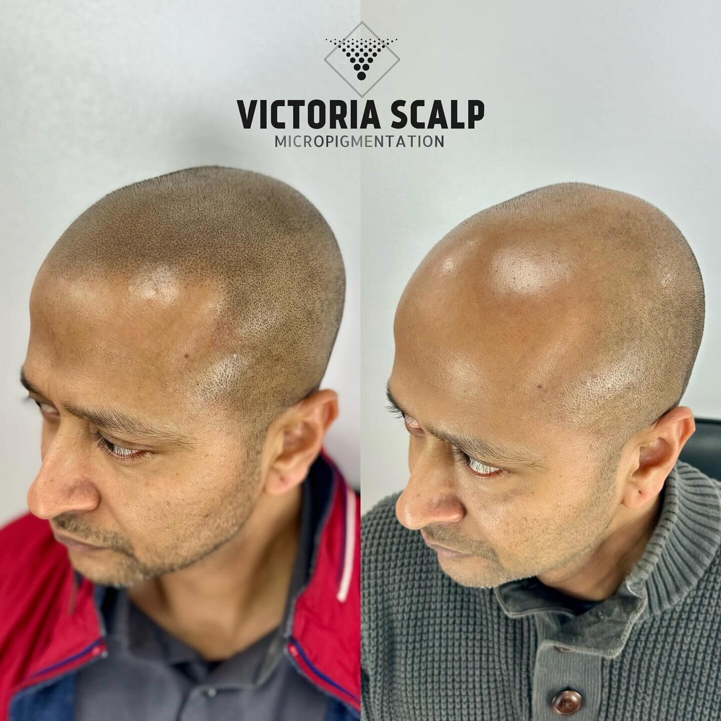 &bull;NATURAL HAIRLINE SMP&bull; 🔥🔥🔥
Before &amp; After 3 Sessions

&gt;&gt;&gt;SWIPE for full zoomable images 

As always, we will check in after a couple months to make sure everything is 💯 perfect for him. 

We want our clients to look and fee
