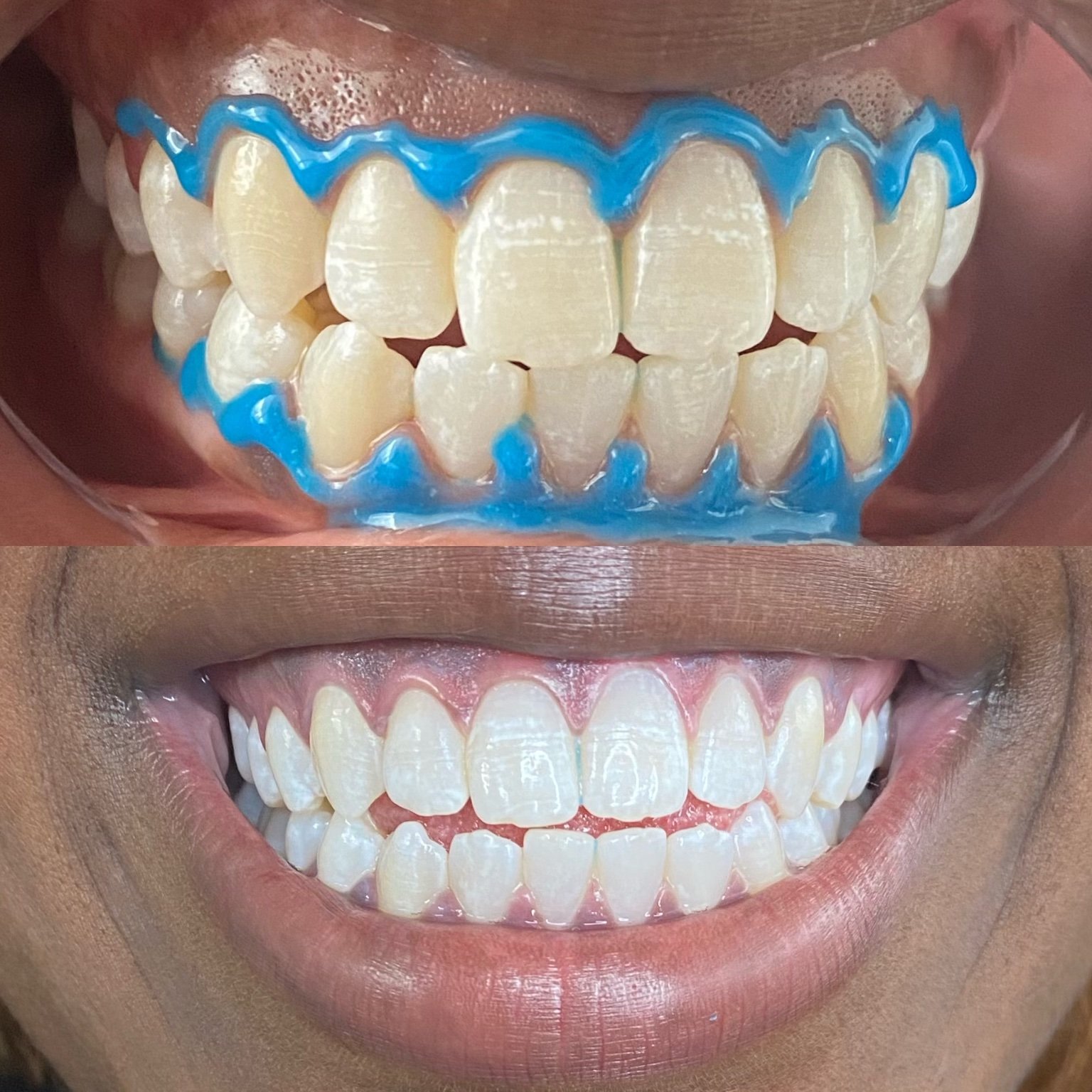 Teeth before and after.jpg