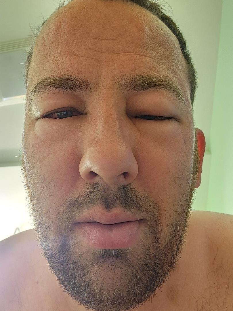 Day 193 - Allergy Attack