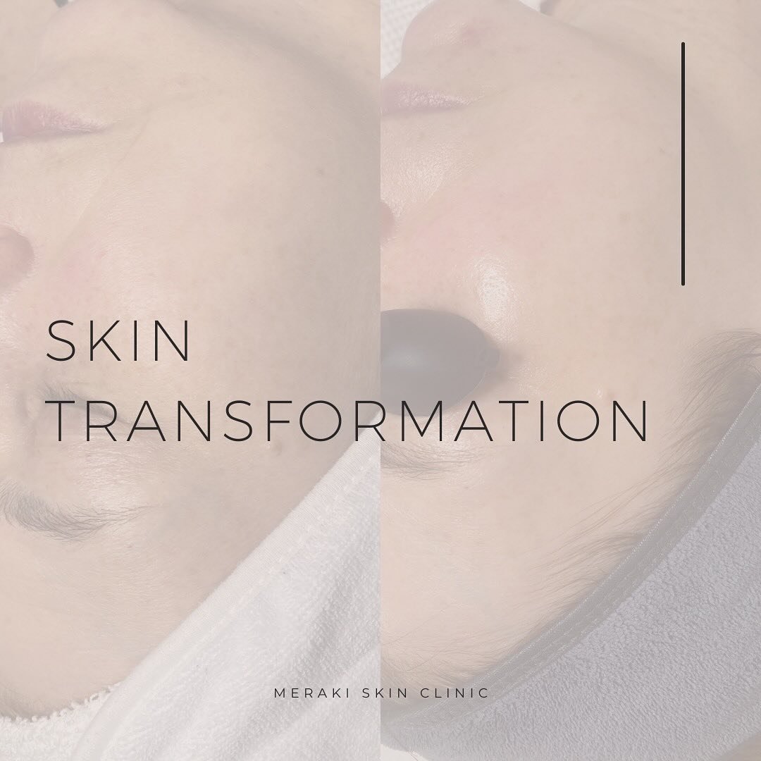 Great results takes time 👏
⠀⠀⠀⠀⠀⠀⠀⠀⠀
Over the past 4 months, my client and I have been on a skin transformation journey to correct dullness, pigmentation and breakouts. 
⠀⠀⠀⠀⠀⠀⠀⠀⠀
By fine-tuning her skincare routine and incorporating monthly Hydrafa