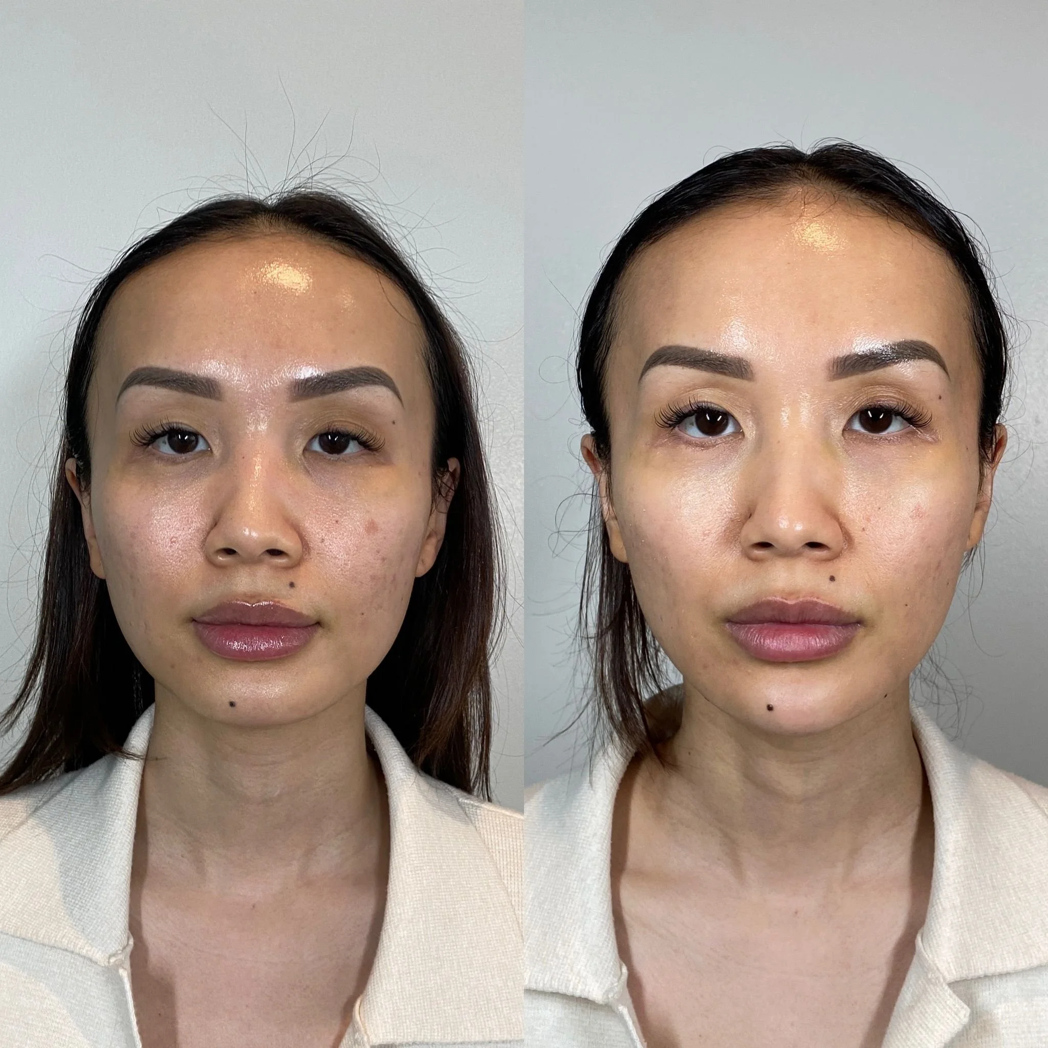Dermal Filler — Meraki Skin Clinic