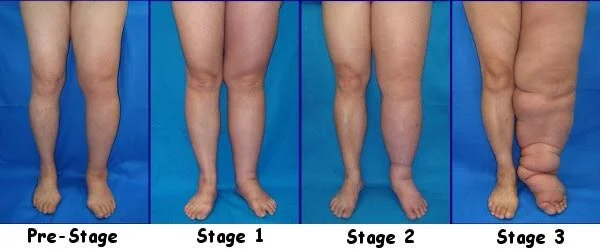 Edema and Lymphedema — Tucson Vein