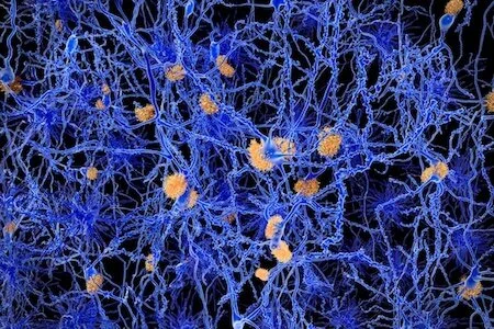 A New Idea About What Triggers Alzheimer’s