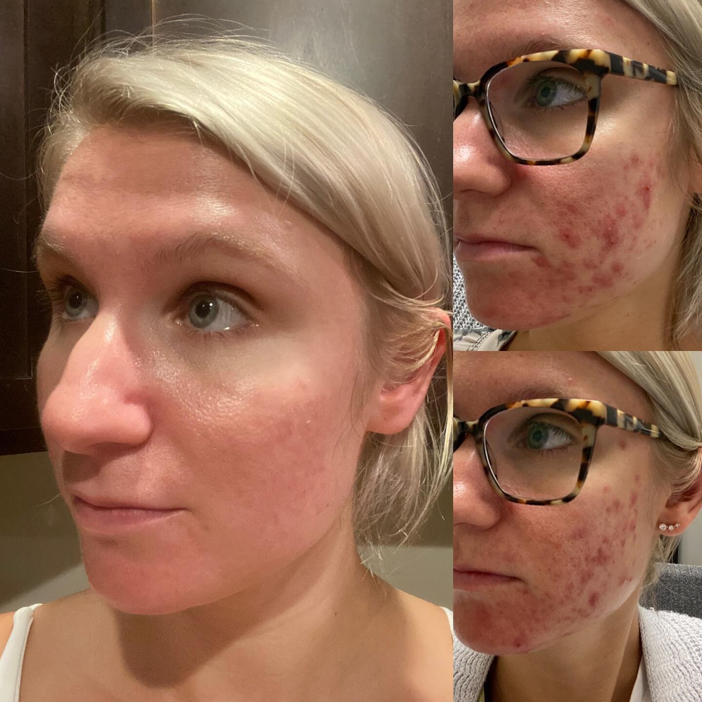 ✨Healing skin one glowy bitch at a time over here!✨

An estie bestie + Face Reality skincare = best skin of your life!

Acne really sucks. There are so many factors for why people struggle with acne &hellip;.from genetics, to diet &amp; gut health, h