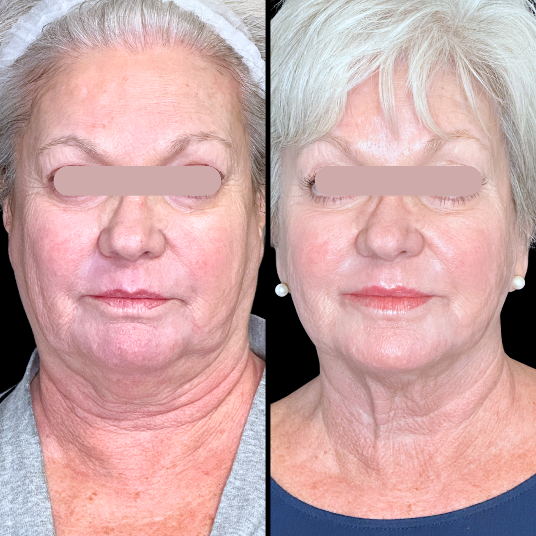 Skincare B&A (2).png